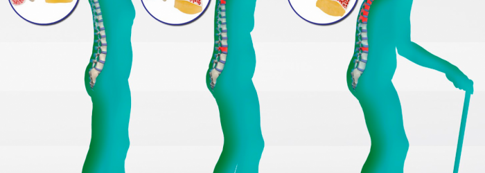 Di prevenzione e cura   dell’osteoporosi e di qualche altra curiosità, di questo tratteremo nella Rubrica di Venerdì 18 Maggio.