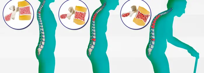 Di prevenzione e cura   dell’osteoporosi e di qualche altra curiosità, di questo tratteremo nella Rubrica di Venerdì 18 Maggio.