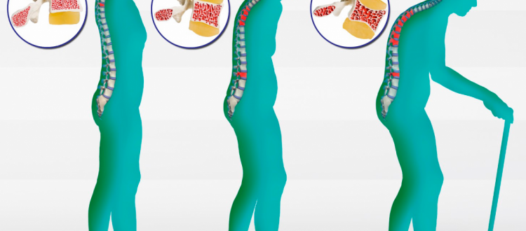 Di prevenzione e cura   dell’osteoporosi e di qualche altra curiosità, di questo tratteremo nella Rubrica di Venerdì 18 Maggio.
