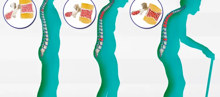 Di prevenzione e cura   dell’osteoporosi e di qualche altra curiosità, di questo tratteremo nella Rubrica di Venerdì 18 Maggio.