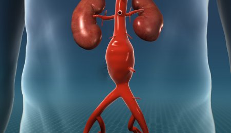 Check-Up Aneurismi Aortici