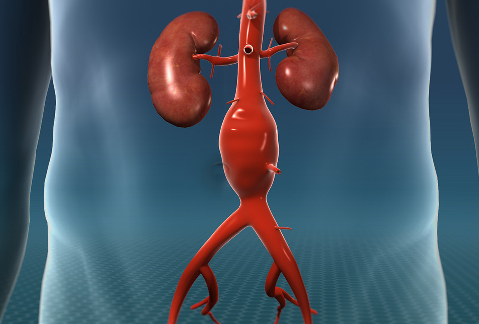 Check-Up Aneurismi Aortici Check-Up Aneurismi Aortici